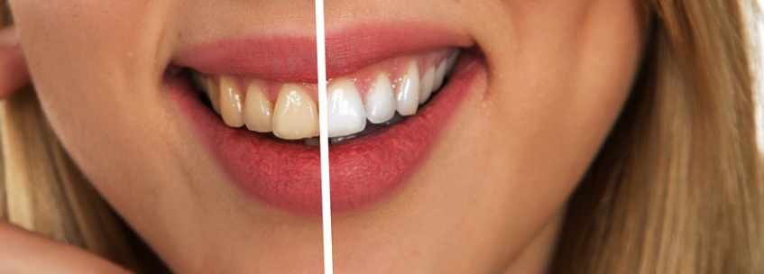 Best teeth whitening products